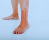 A chemical burn that turned into a rash on a senior women's foot
