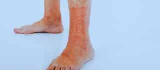 A chemical burn that turned into a rash on a senior women's foot
