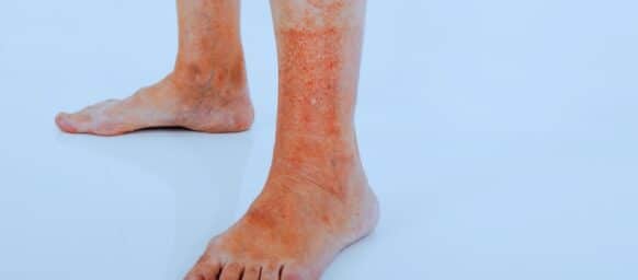 A chemical burn that turned into a rash on a senior women's foot