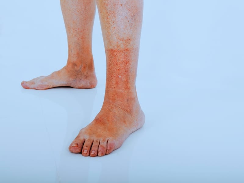 What To Know About A Chemical Burn Injury Claim Strong Law Offices