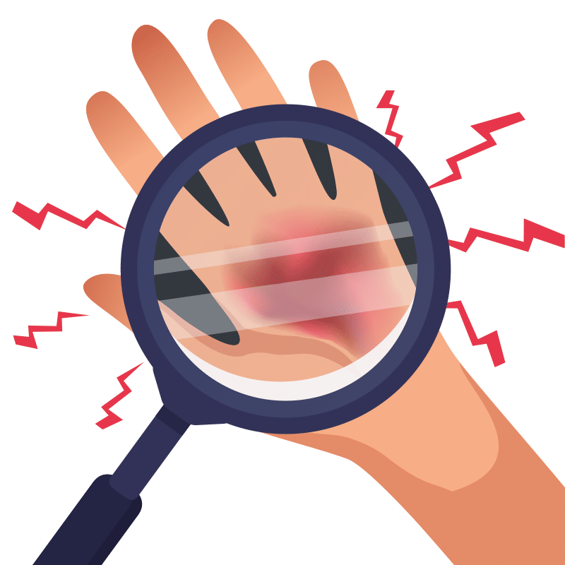 Graphical illustration of a burnt hand and a magnifying glass